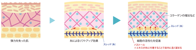 干细胞埋线优势