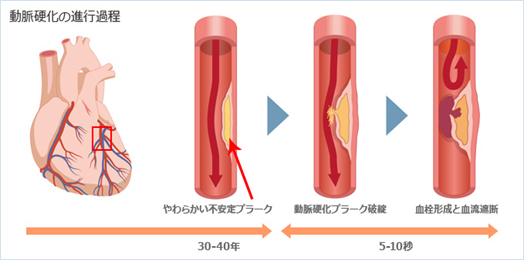 急性心肌梗塞是怎么引起的